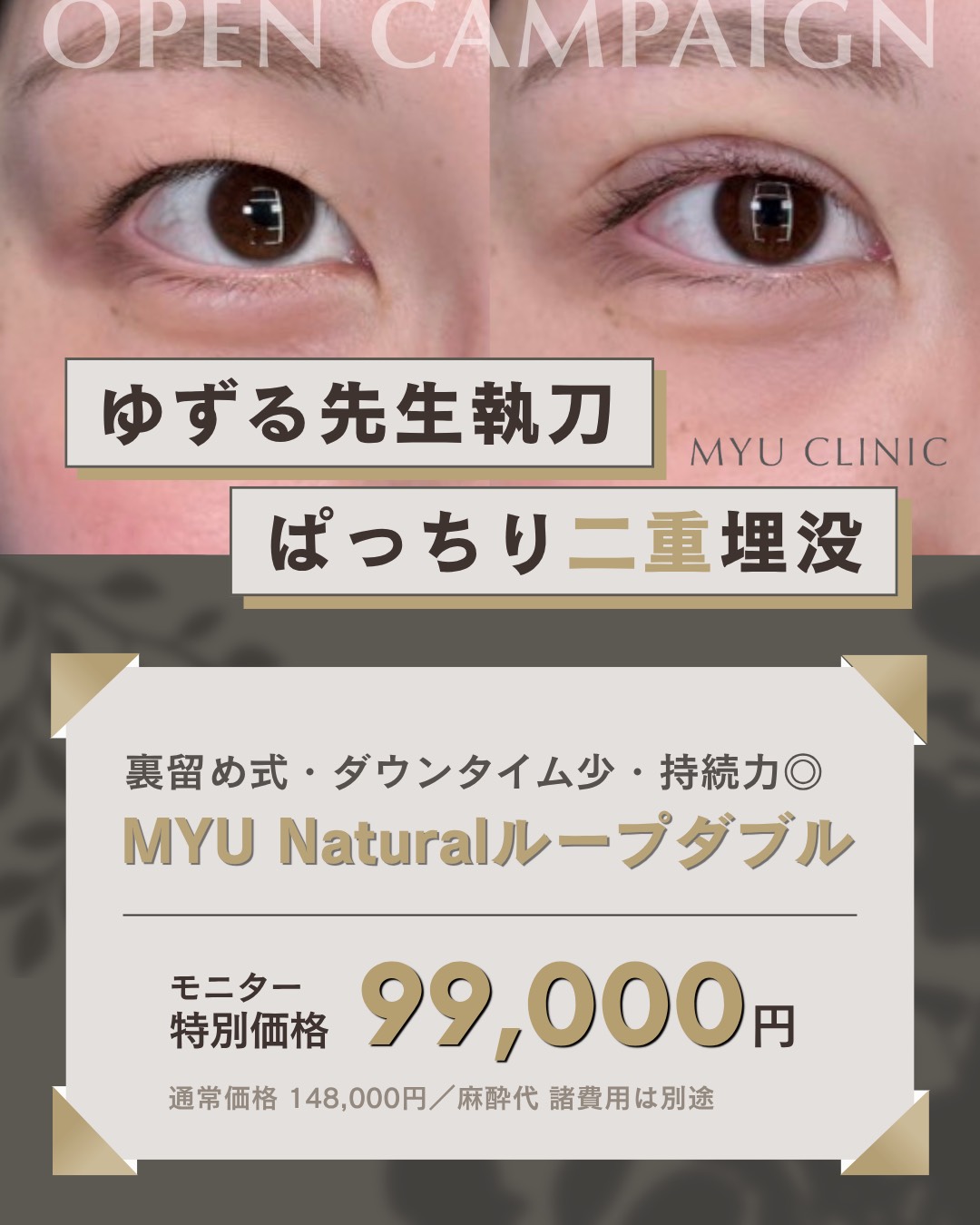 ゆずる先生執刀 ぱっちり二重埋没 MYU Naturalループダブル モニター特別価格99,000円