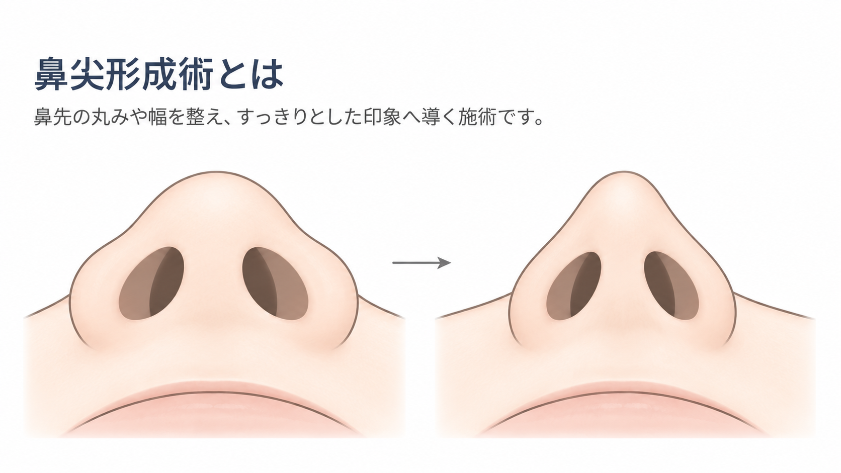 鼻尖形成術のイメージ