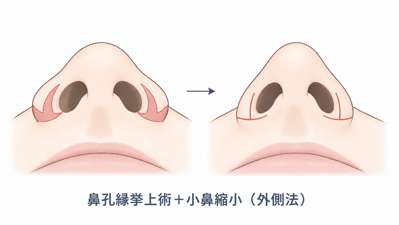鼻孔縁挙上術と小鼻縮小外側法