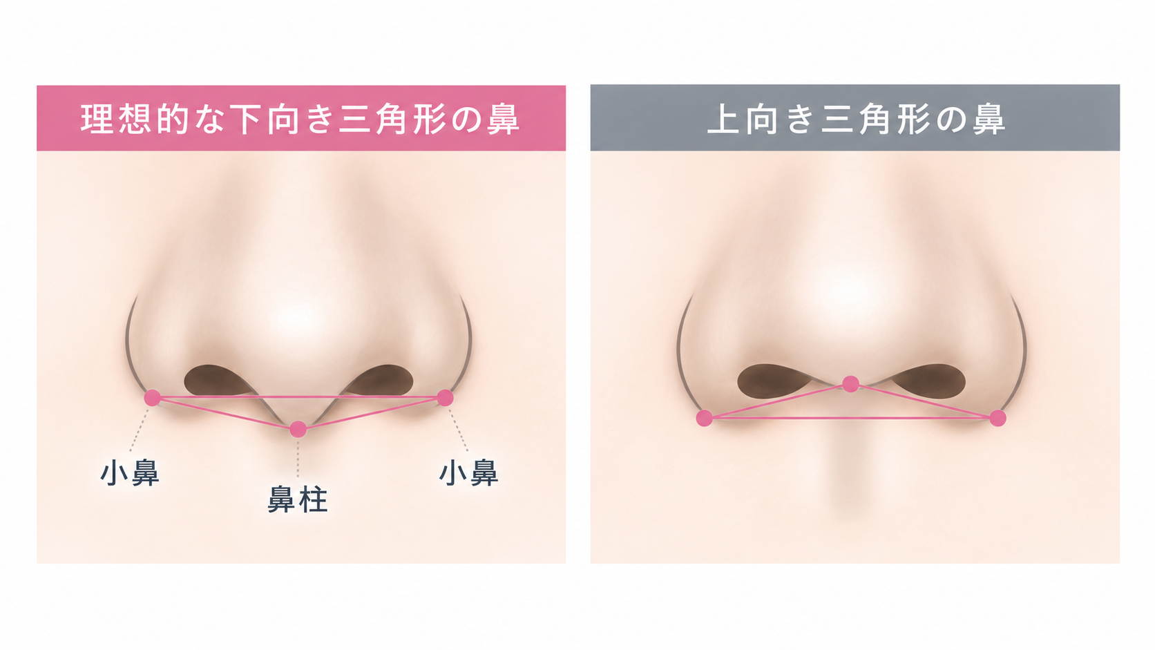 小鼻と鼻柱の位置関係(ACR)