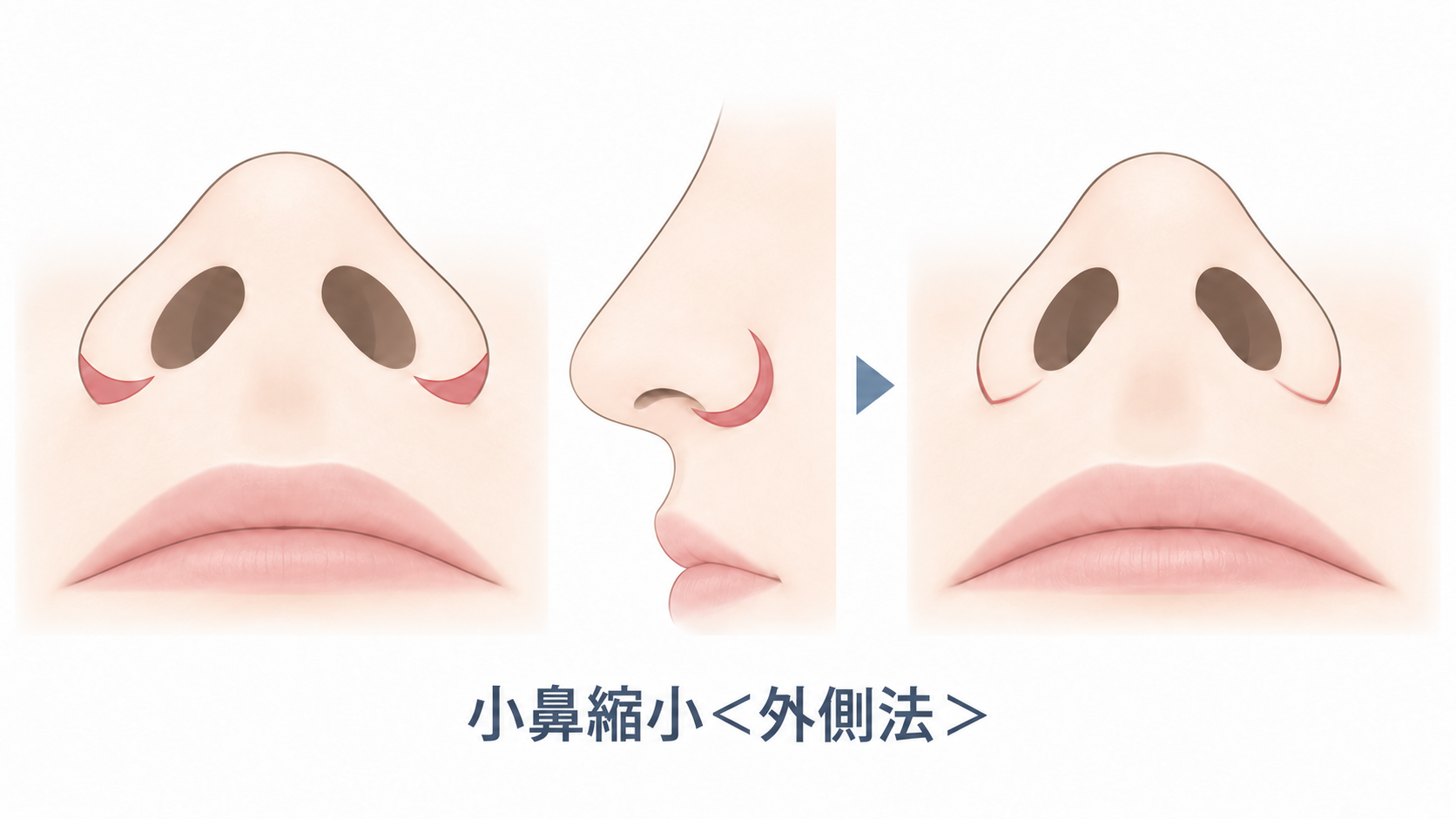 小鼻縮小の外側法
