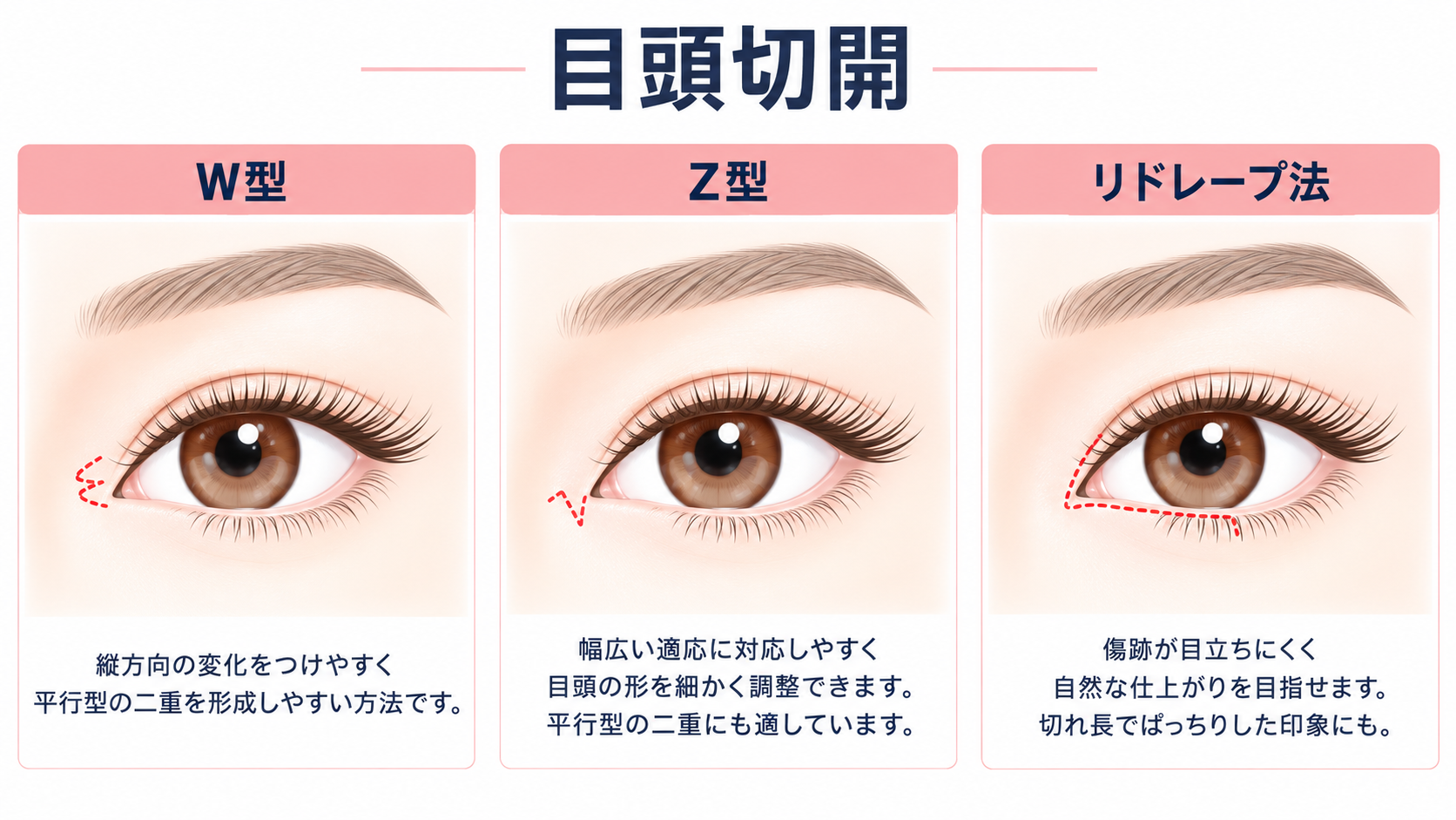 目頭切開のW型・Z型・リドレープ法の比較