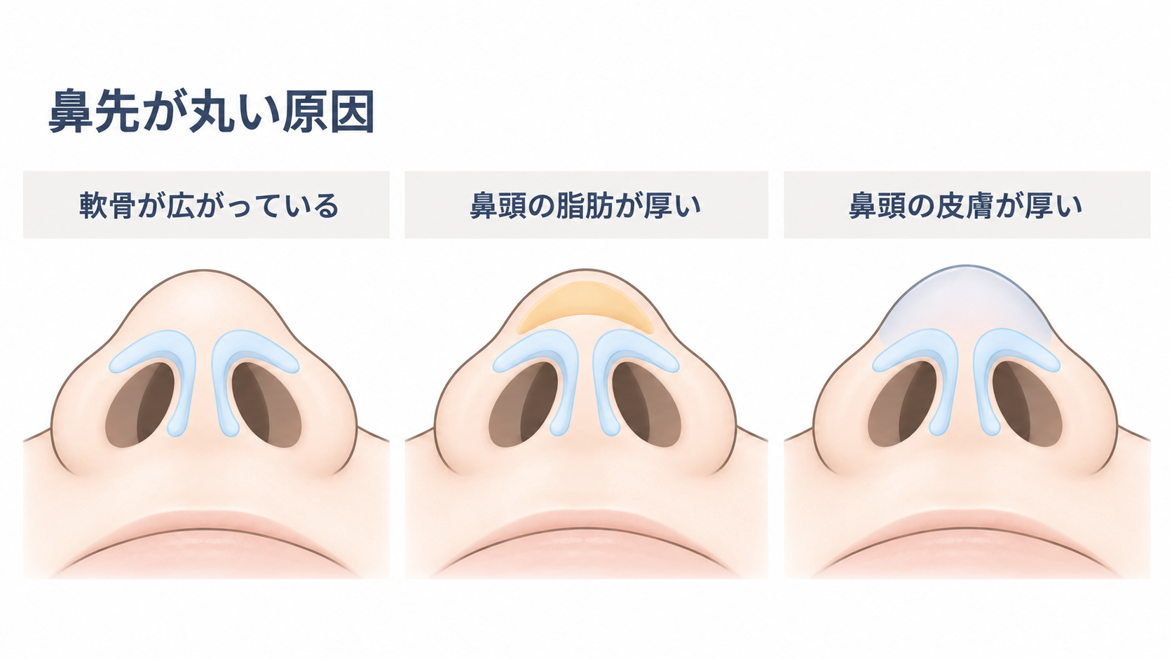 鼻先が丸くなる原因