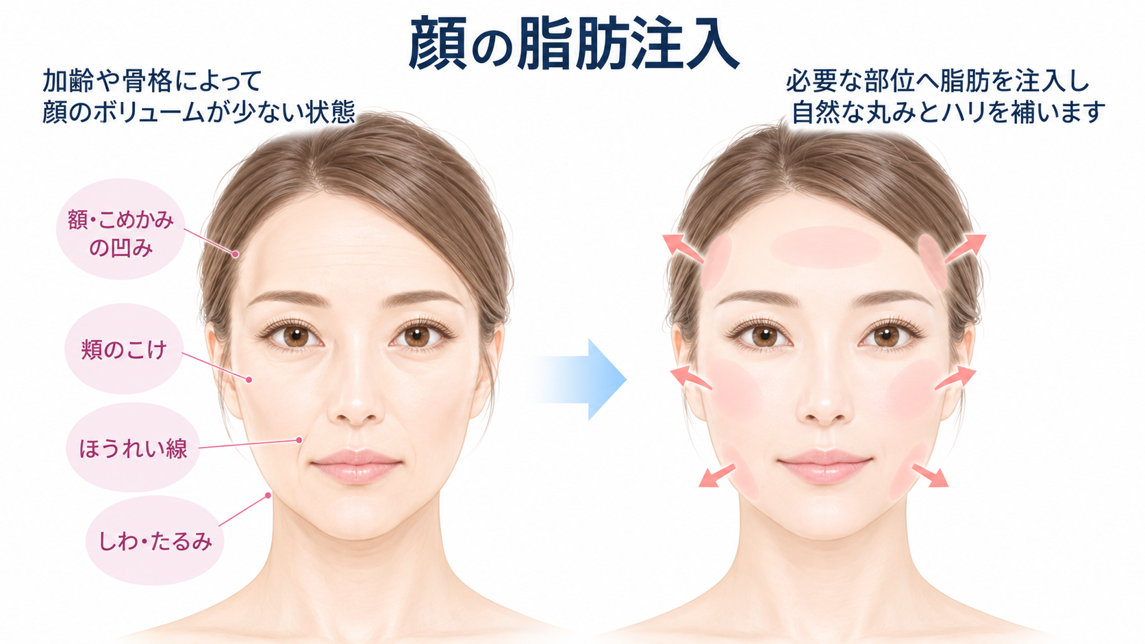 顔の脂肪注入：額・こめかみ・頬などのボリュームを補うイメージ