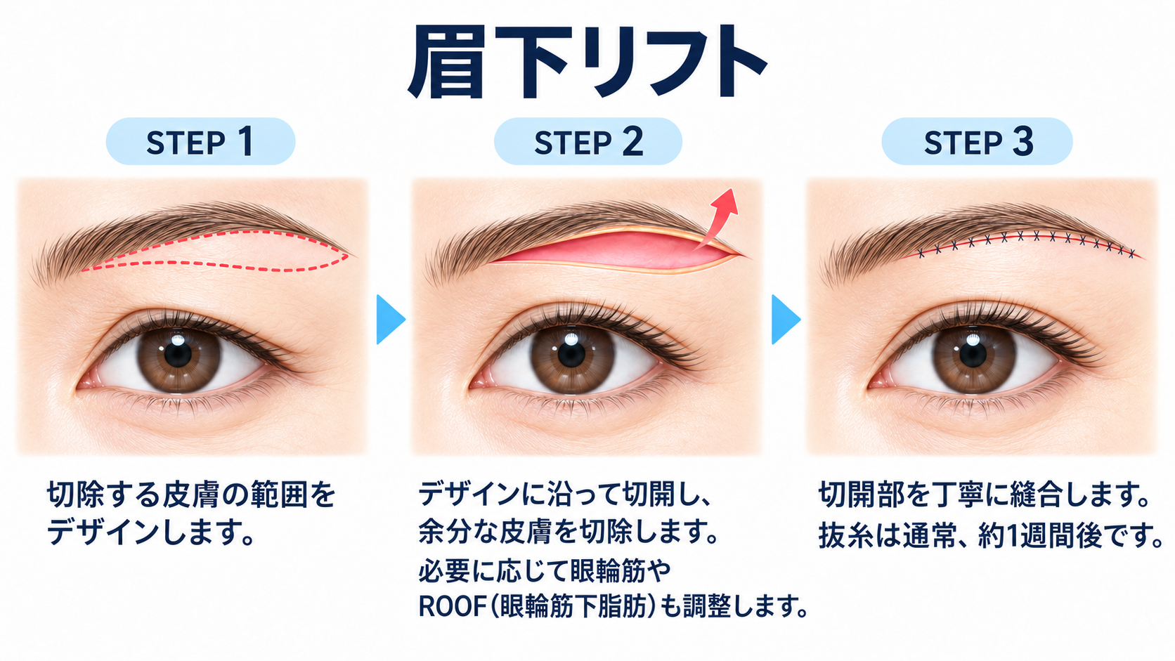 眉下リフトの施術手順