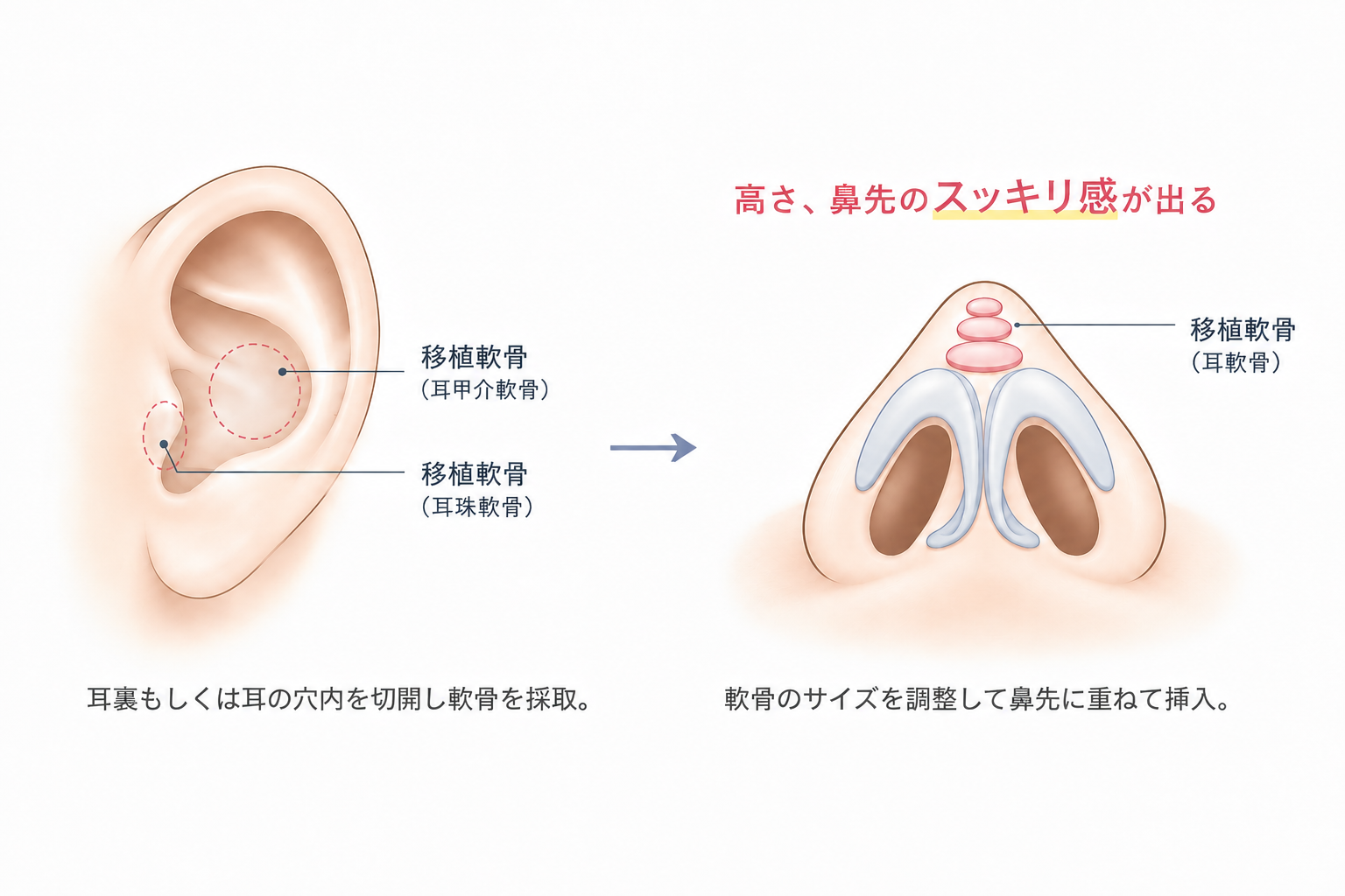 耳軟骨の採取と鼻先への移植