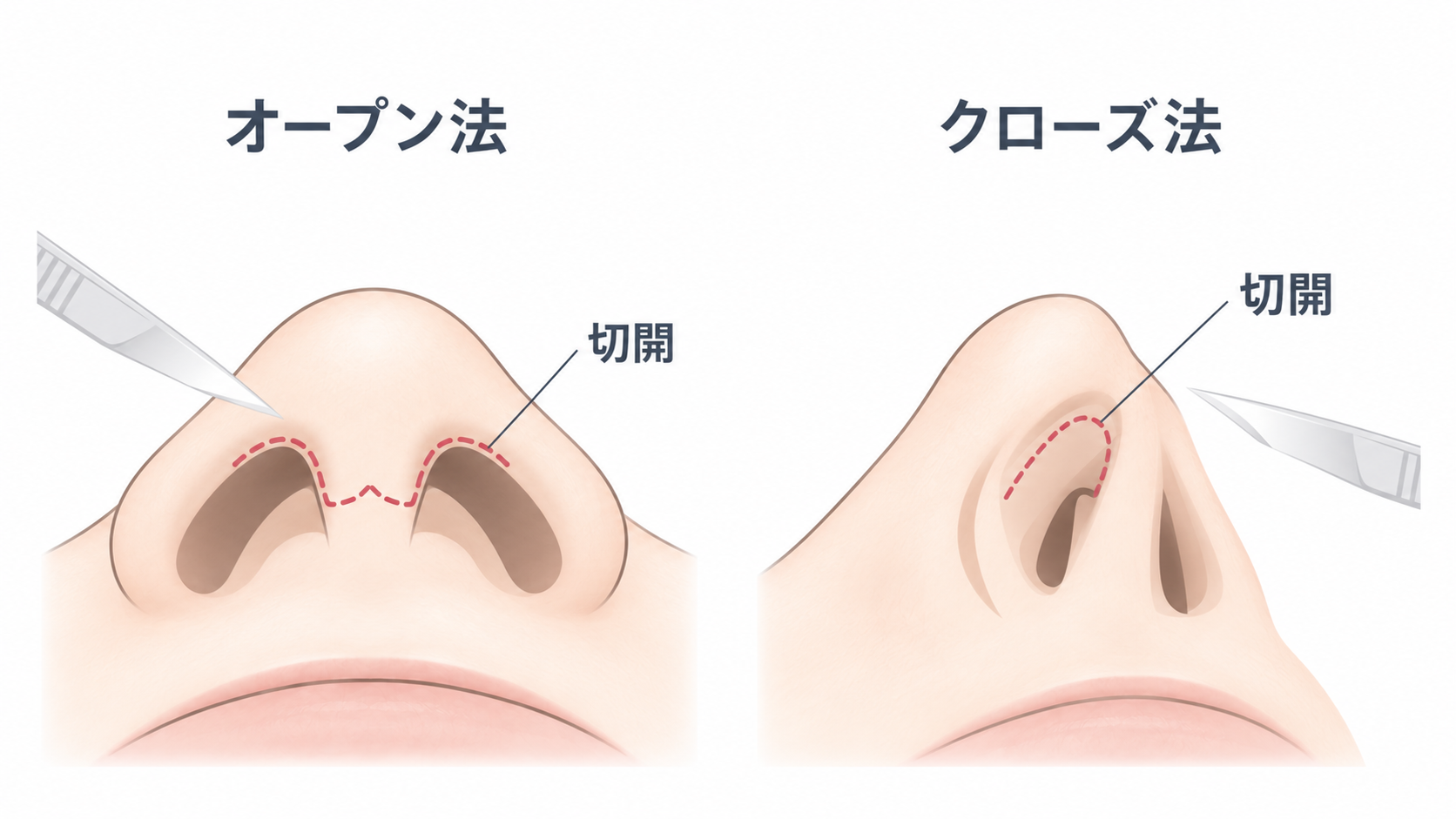 オープン法とクローズ法