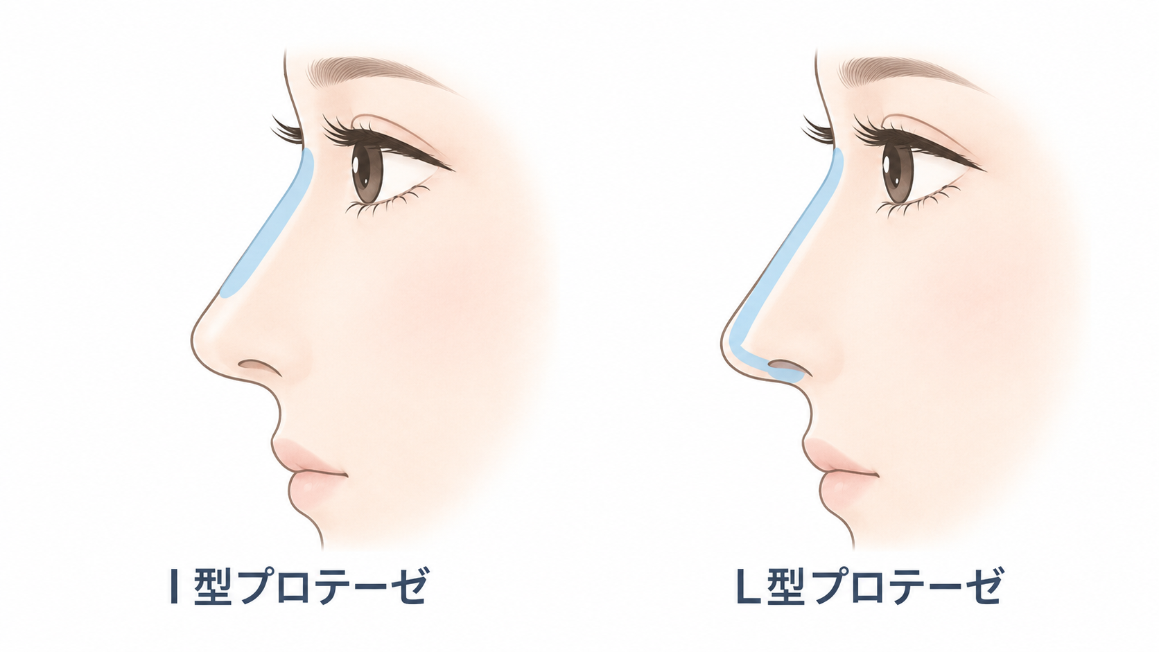I型とL型の鼻プロテーゼ