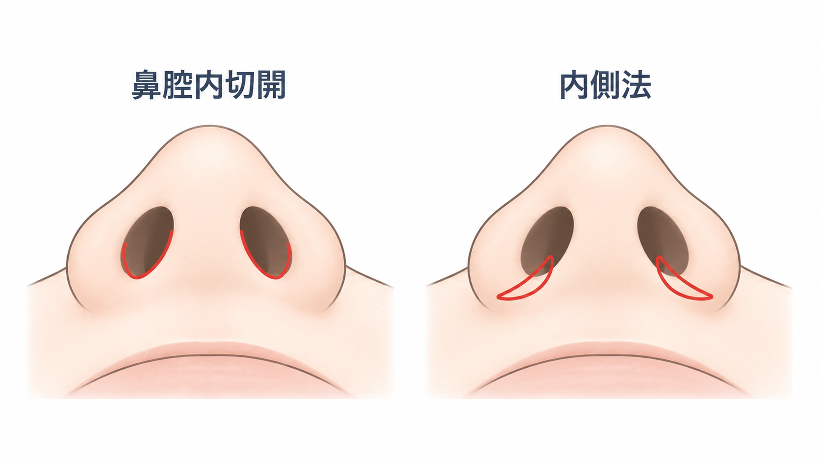 小鼻縮小の鼻腔内切開法と内側法