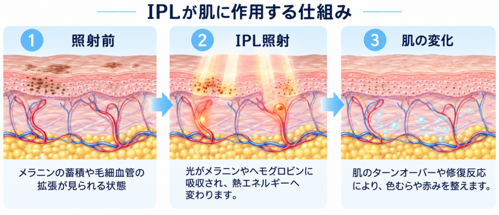 IPLが肌に作用する仕組み
