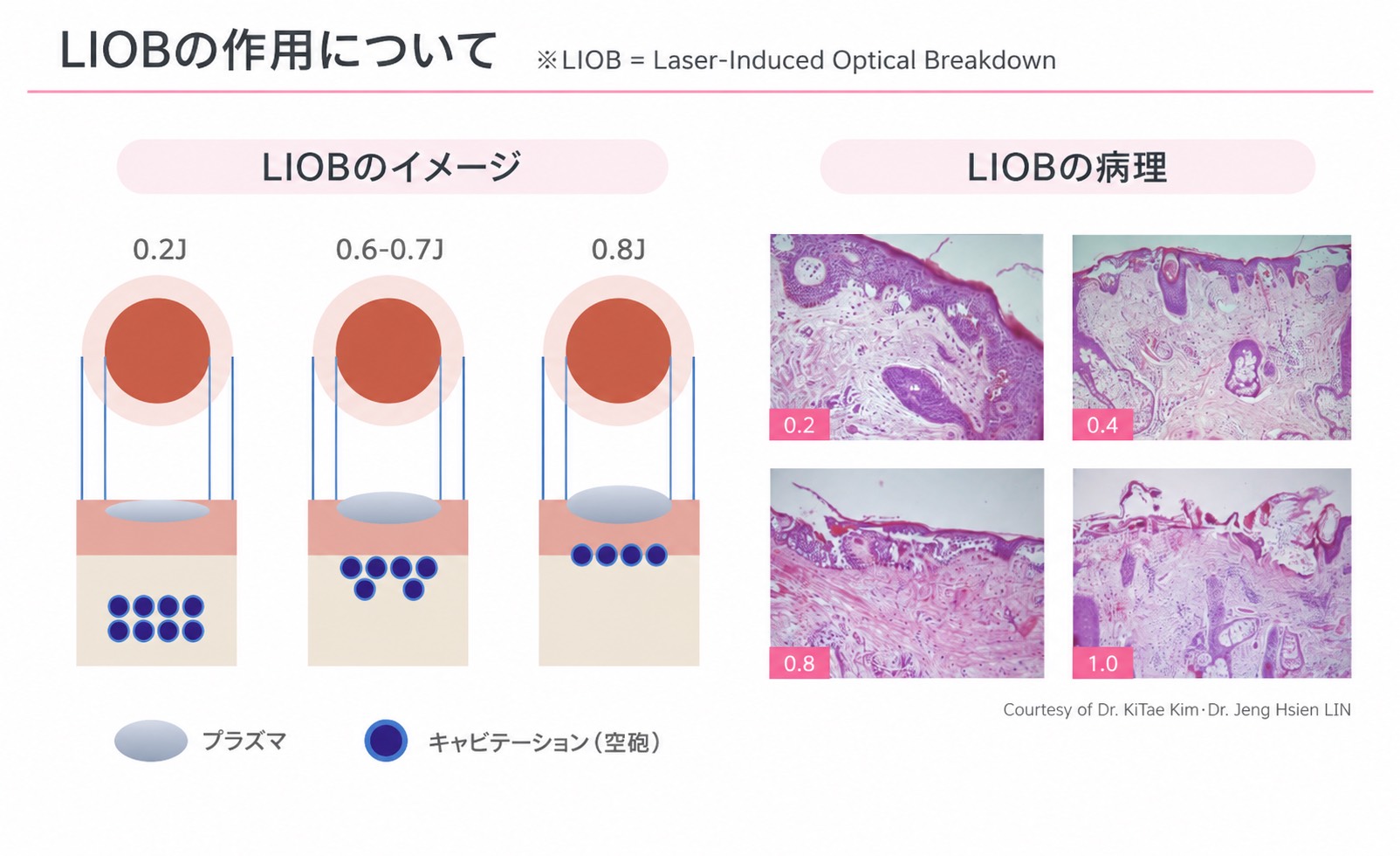 LIOB(レーザー誘起光学破壊)の作用イメージと病理像