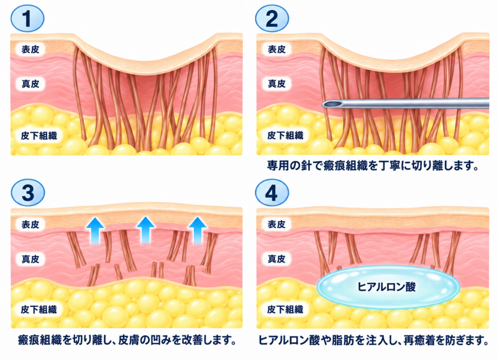 サブシジョンの仕組み