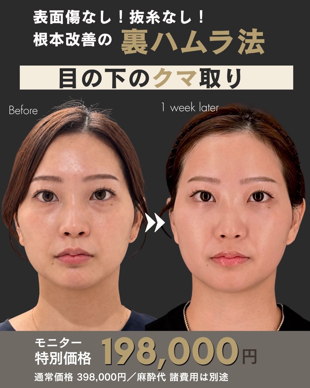 【ゆずる先生執刀】目の下のクマ取り